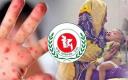 হাম ও হামের উপসর্গে মৃত্যু  প্রায় ৫০০ 