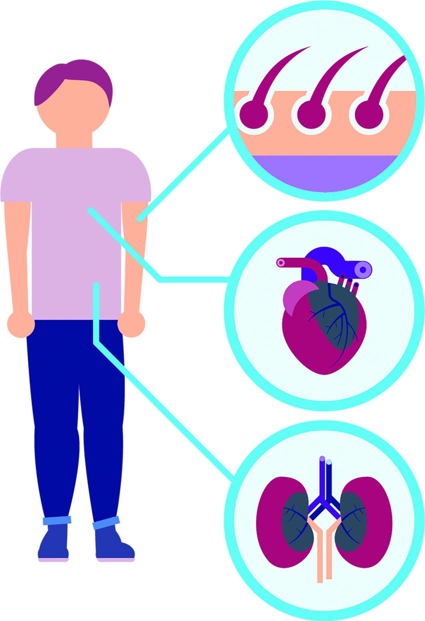 Fabry Disease Is Rare But Very Serious