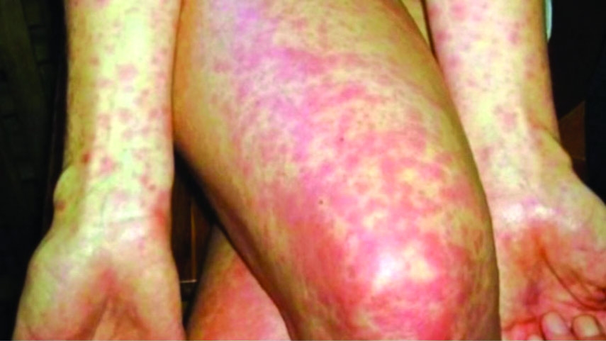 Scarlet Fever: A Once-Feared Disease Making a Comeback!