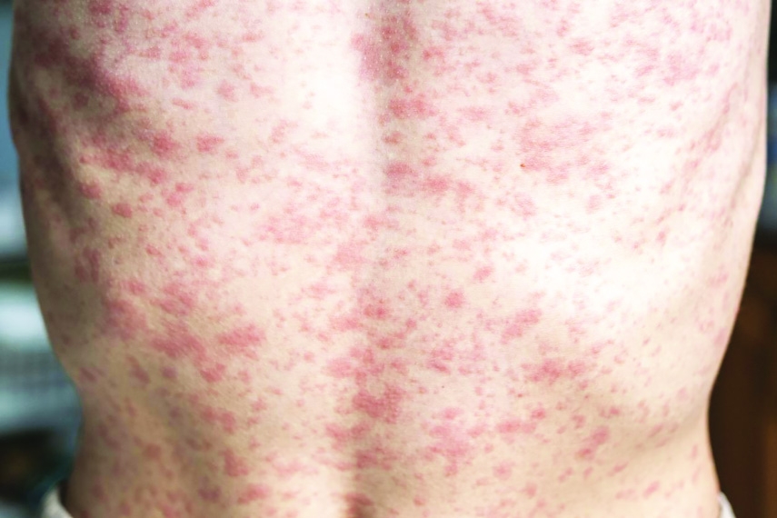 A Comparative Study of Measles in Foreign Countries and Bangladesh and What to Do