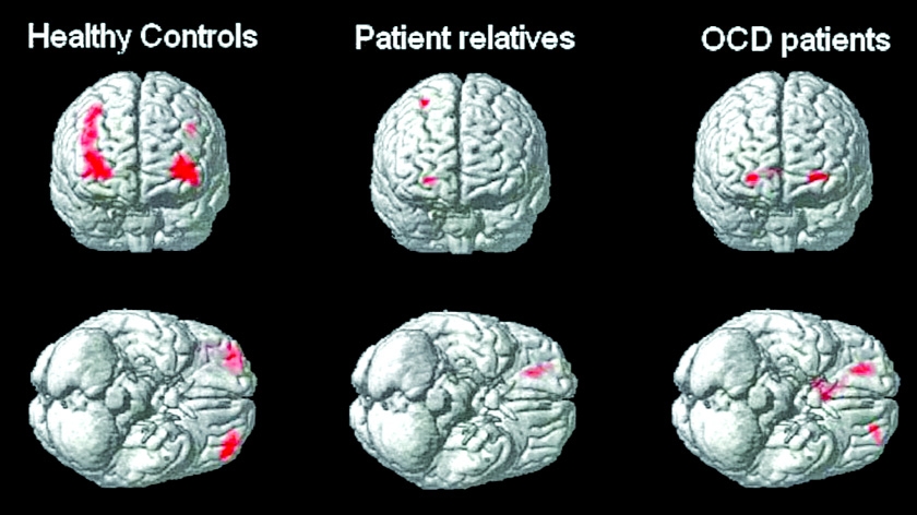 Scientists find OCD genes, opening door to new treatments