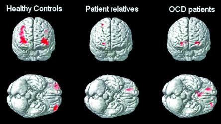 Scientists find OCD genes, opening door to new treatments
