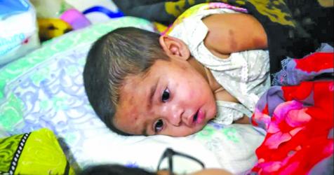 10 more die of measles,  similar symptoms